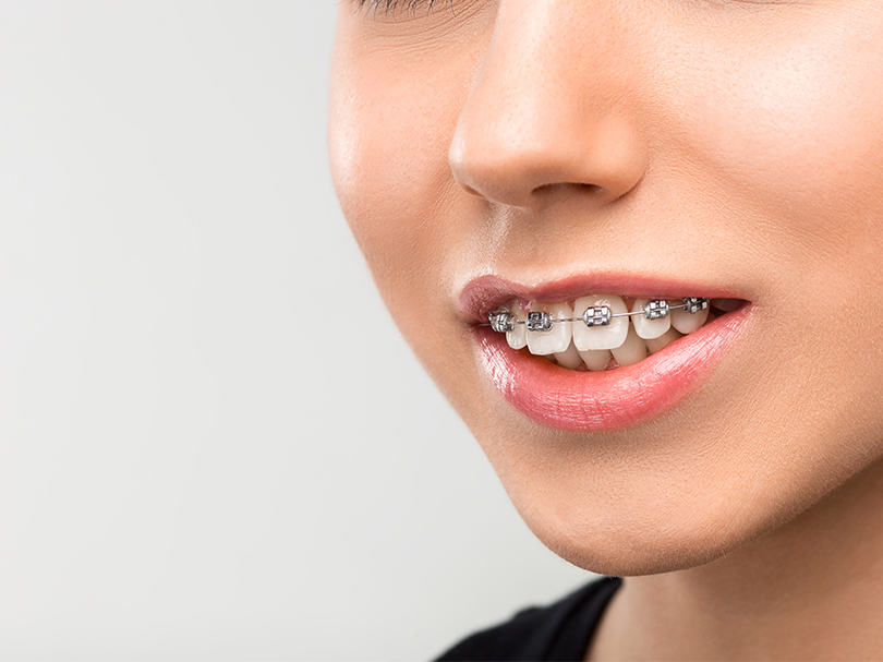 orthosquare teeth braces